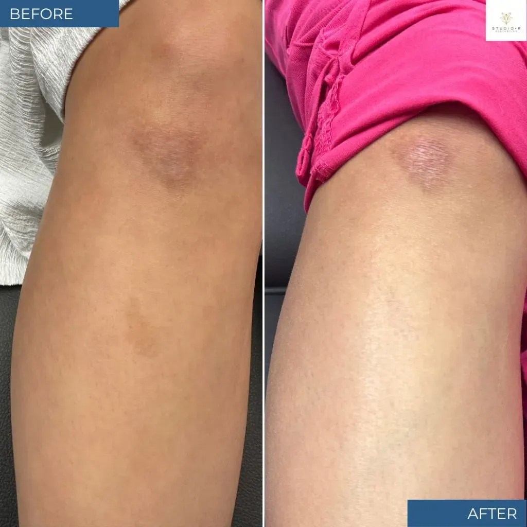 Bbl Moxi Before & After