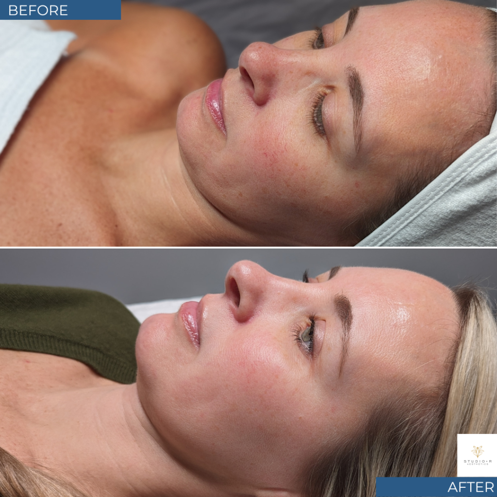 Bbl Moxi Before & After