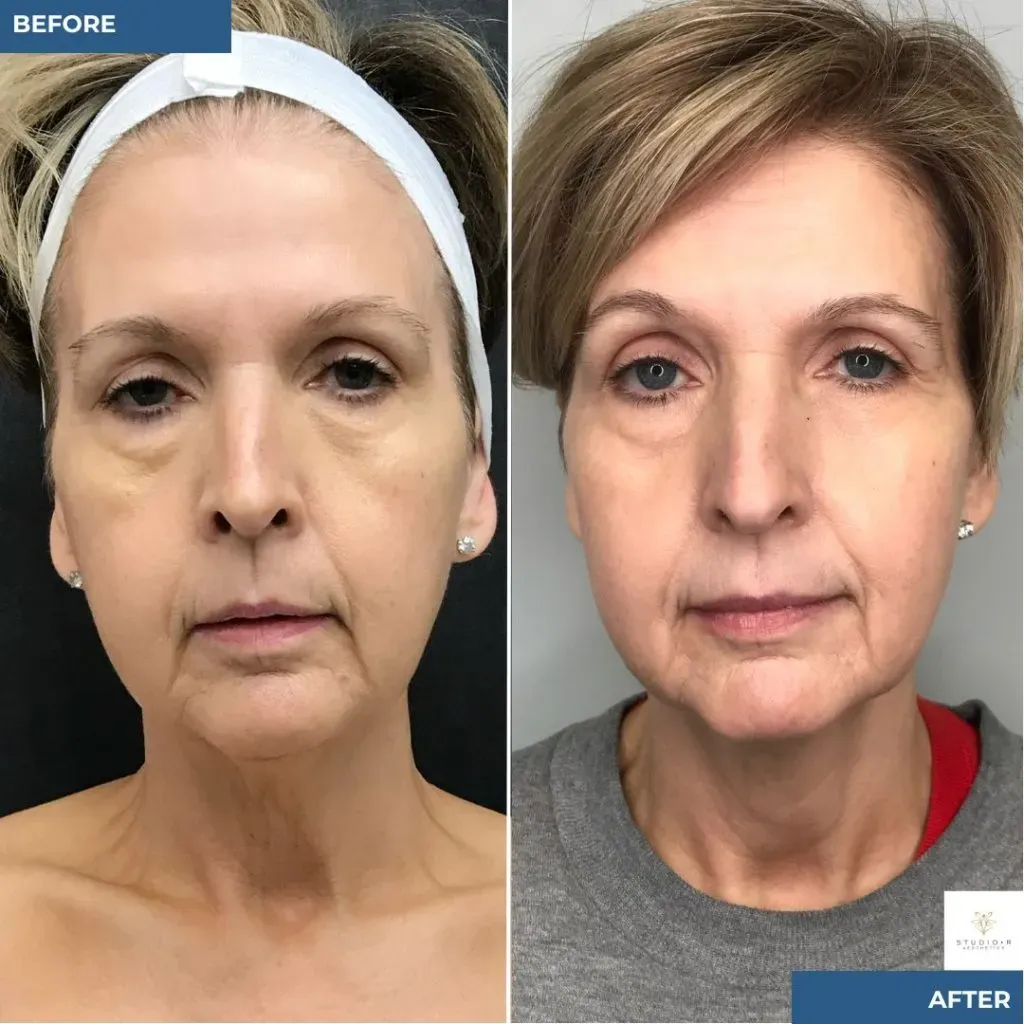 Rf Microneedling Before & After