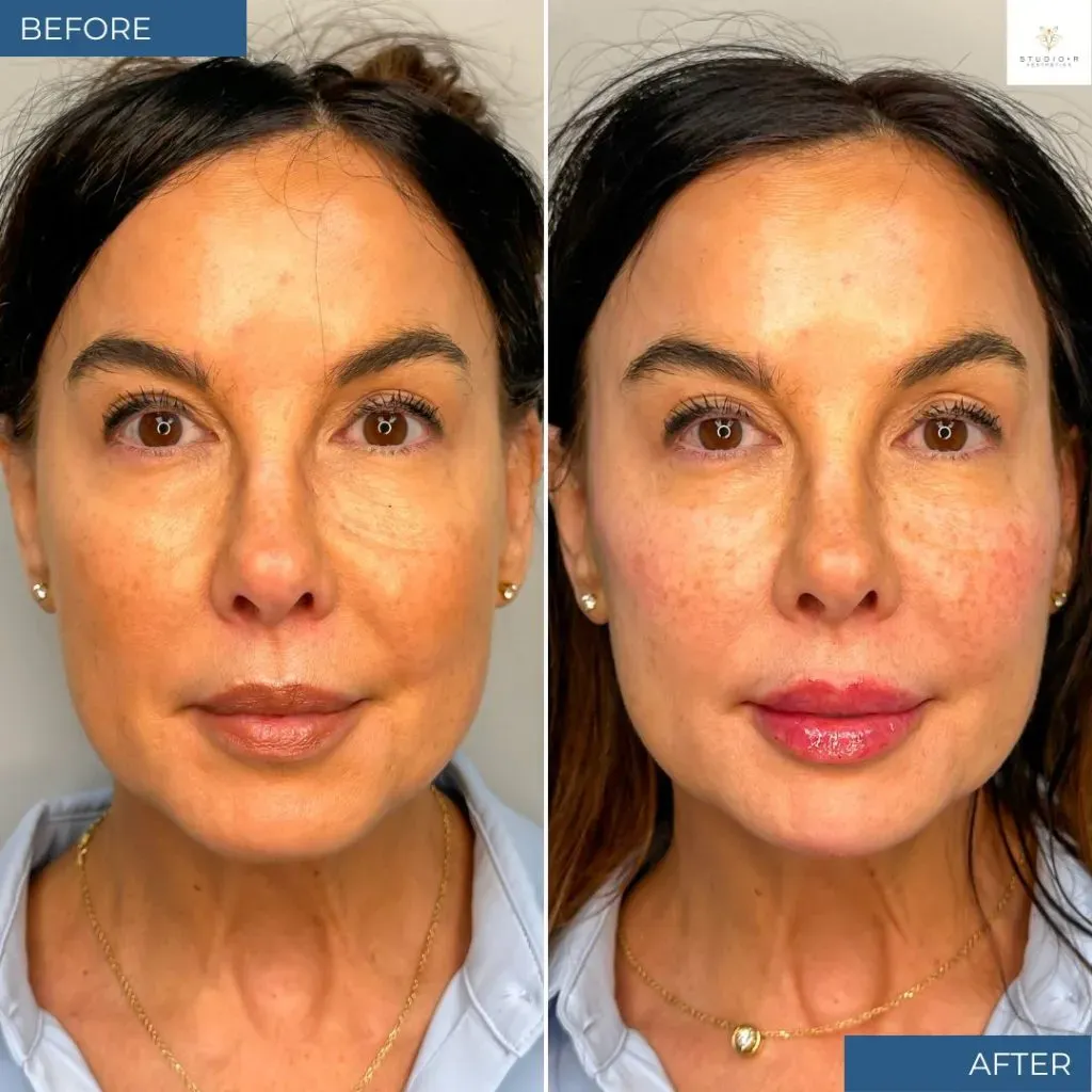 Facial Filler Before & After