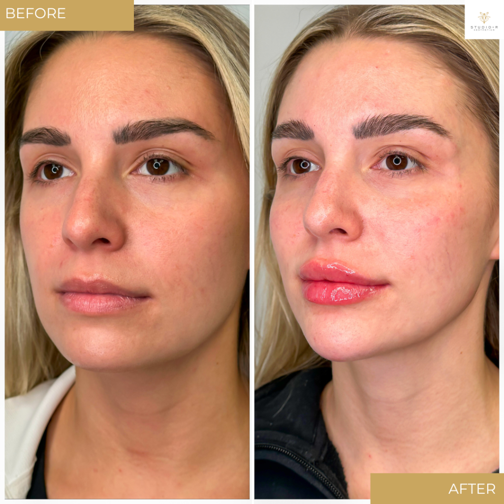 Facial Filler Before & After