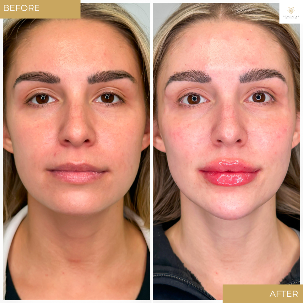 Facial Filler Before & After