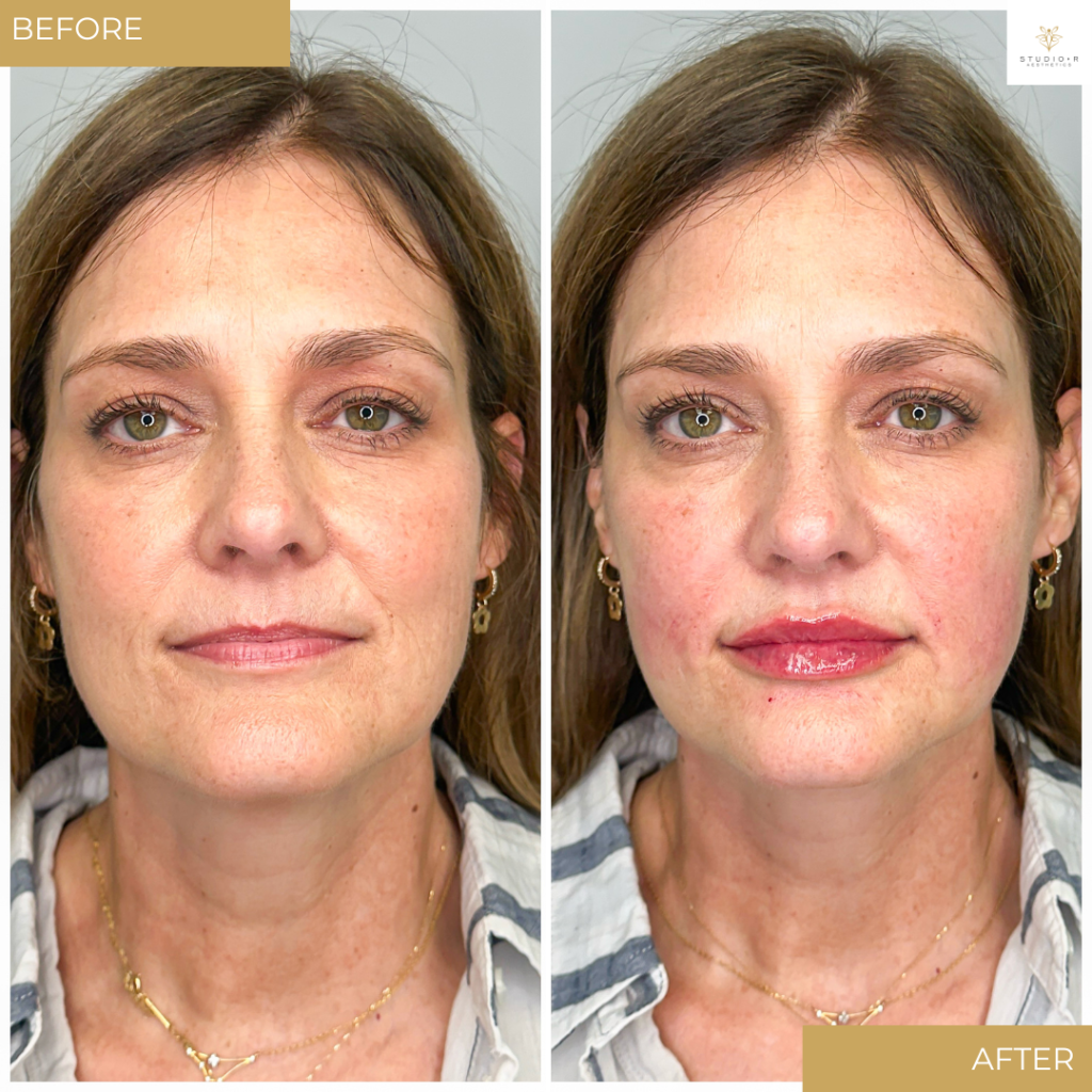 Facial Filler Before & After