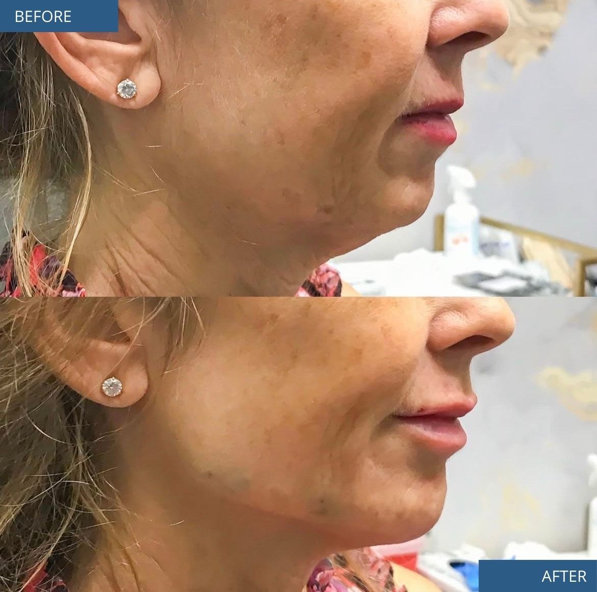 Facial Filler Before & After