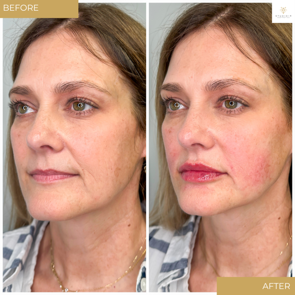 Facial Filler Before & After