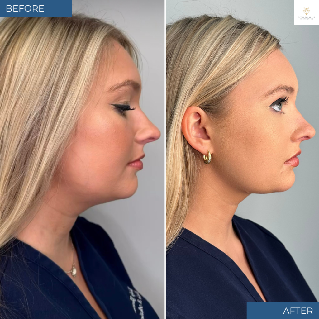 Kybella Lipodissolve Before & After