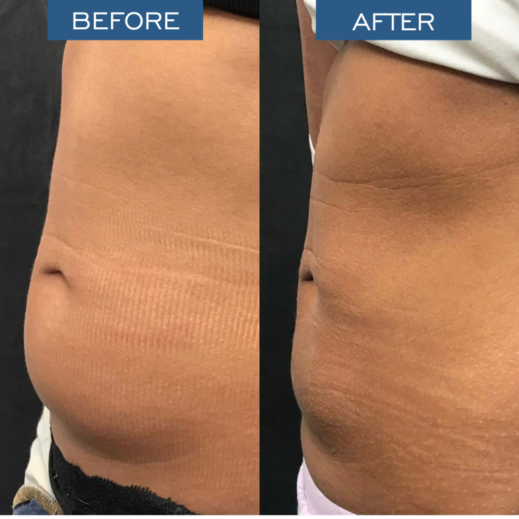 Kybella Lipodissolve Before & After