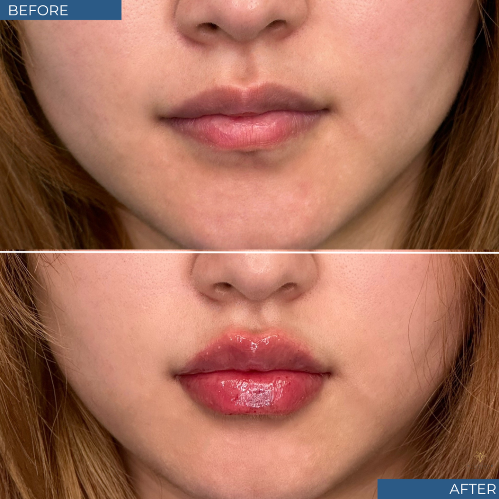 Lip Filler Before & After