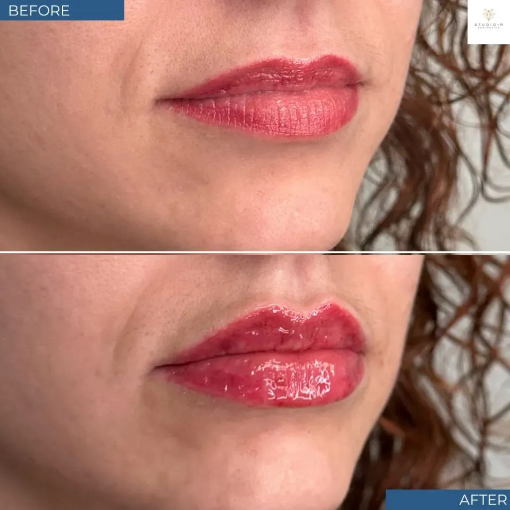Lip Filler Before & After
