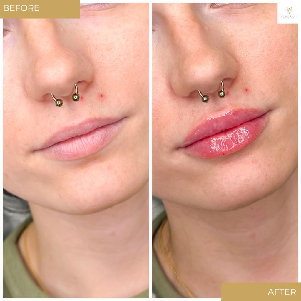 Lip Filler Before & After