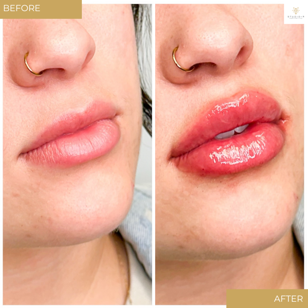 Lip Filler Before & After