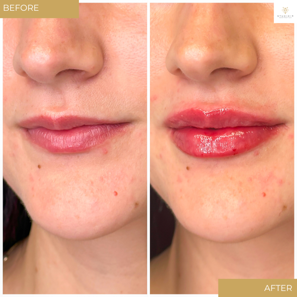 Lip Filler Before & After