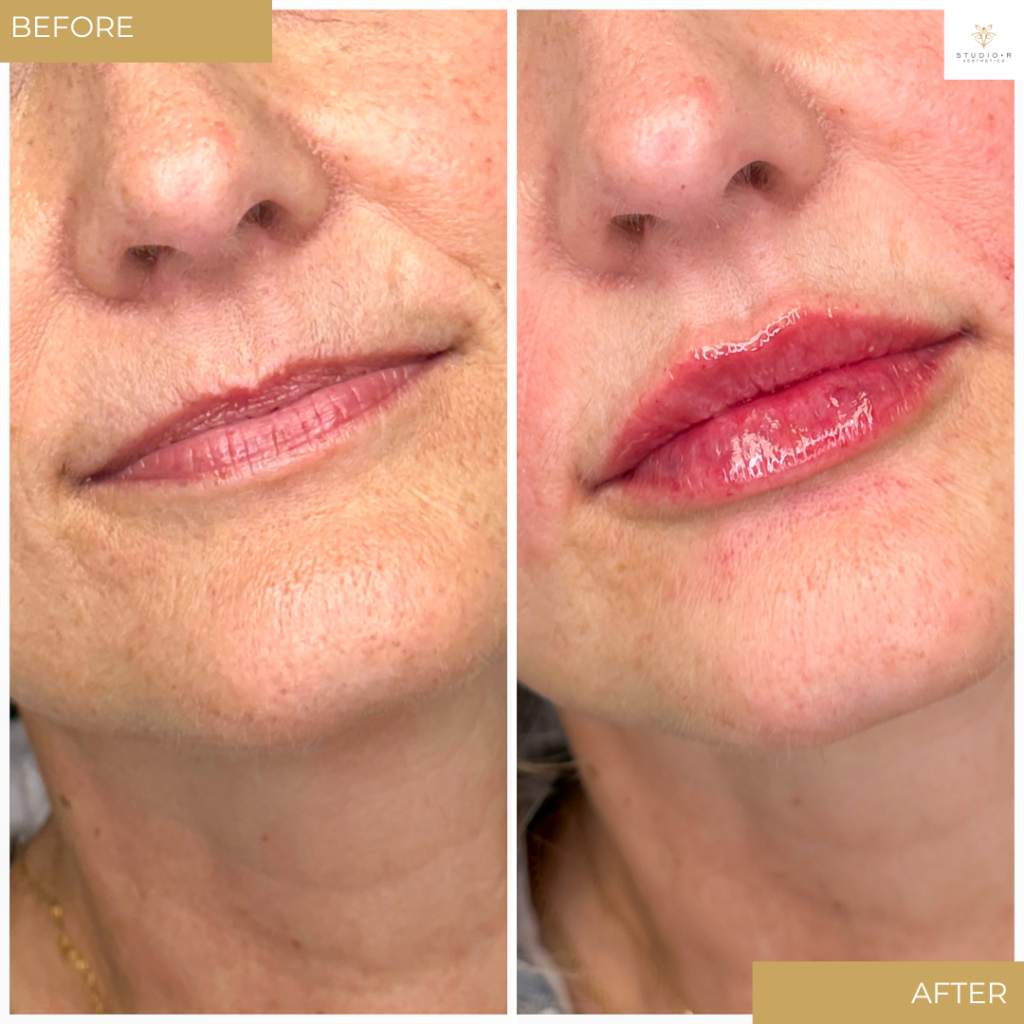 Lip Filler Before & After