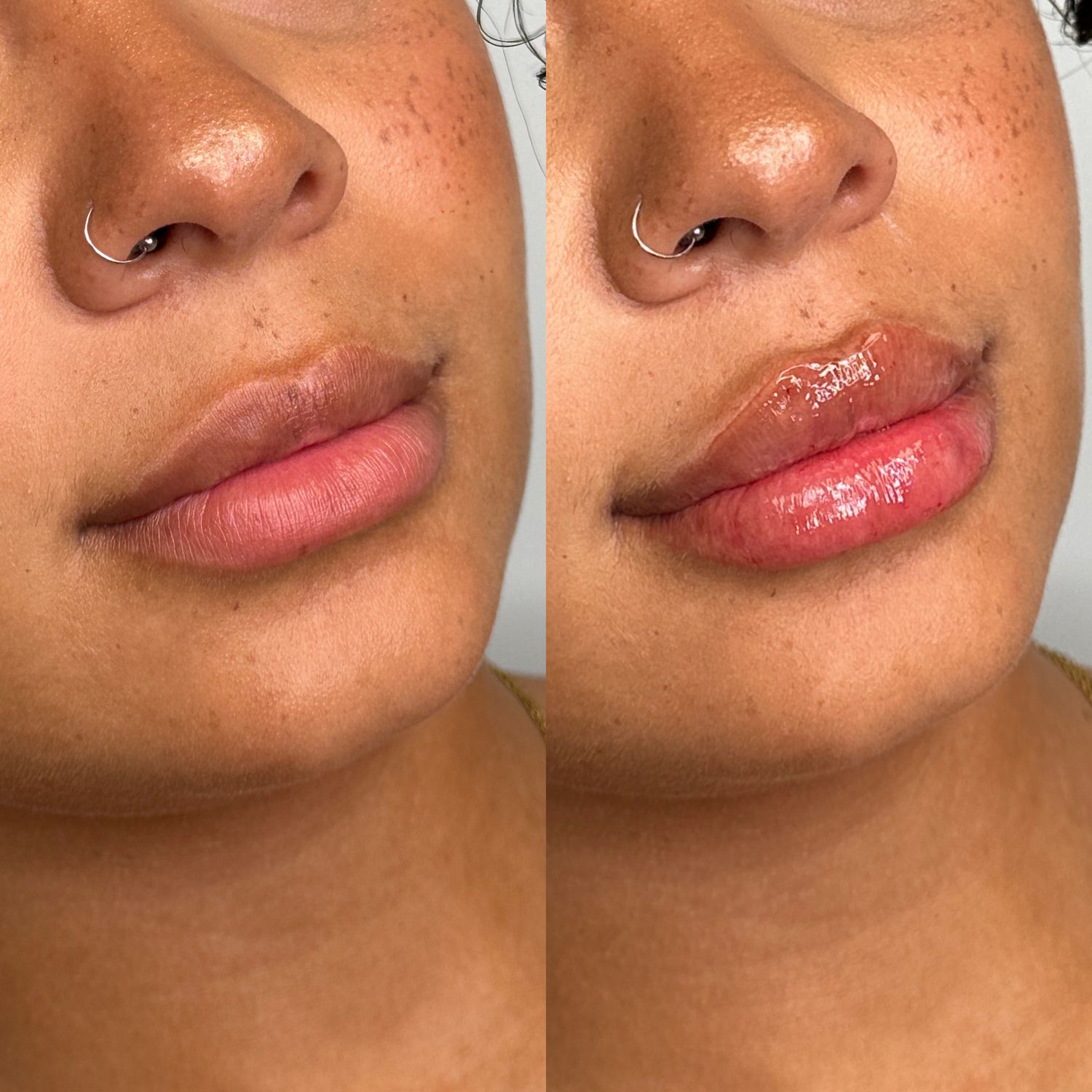 Lip Filler Before & After