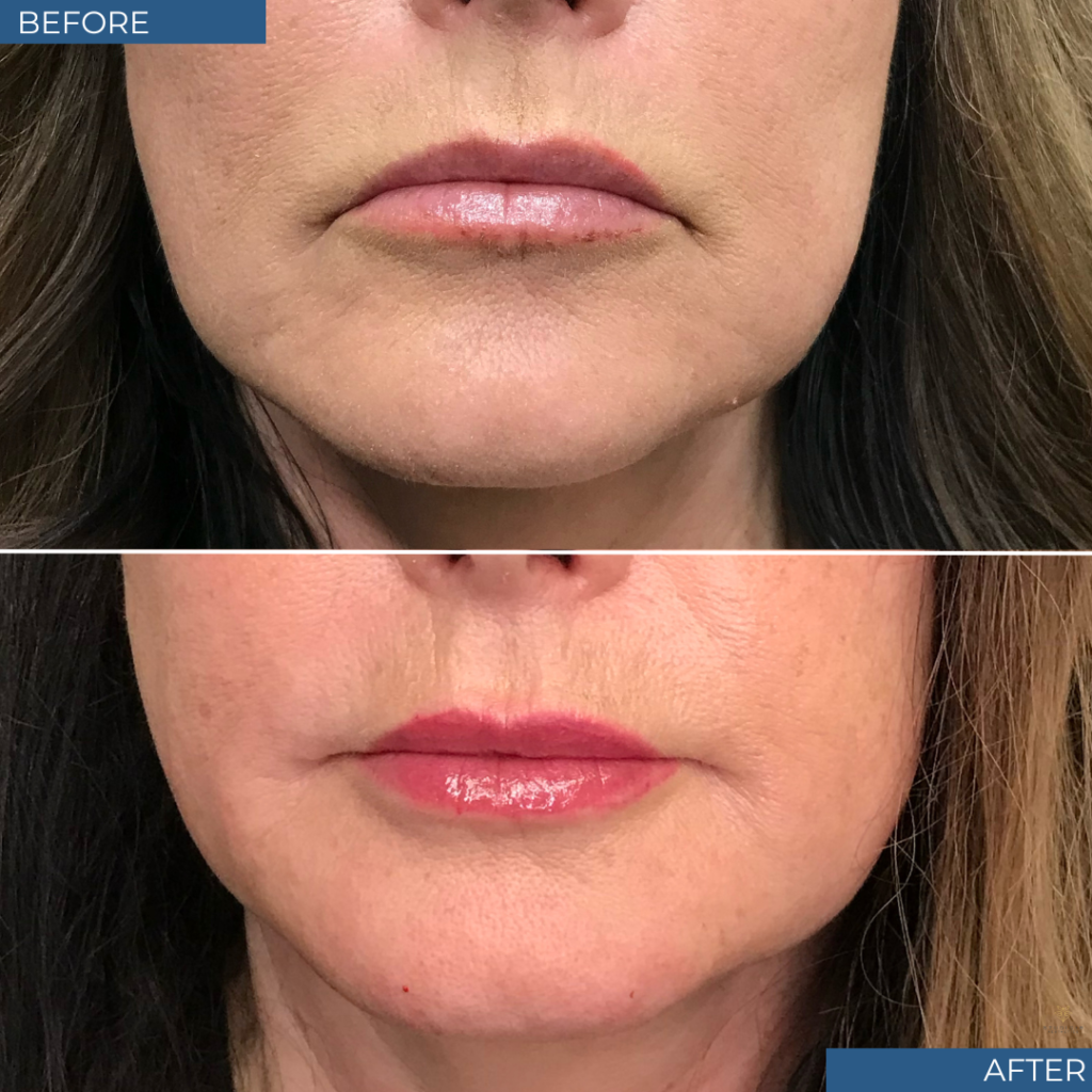 Botox Before & After