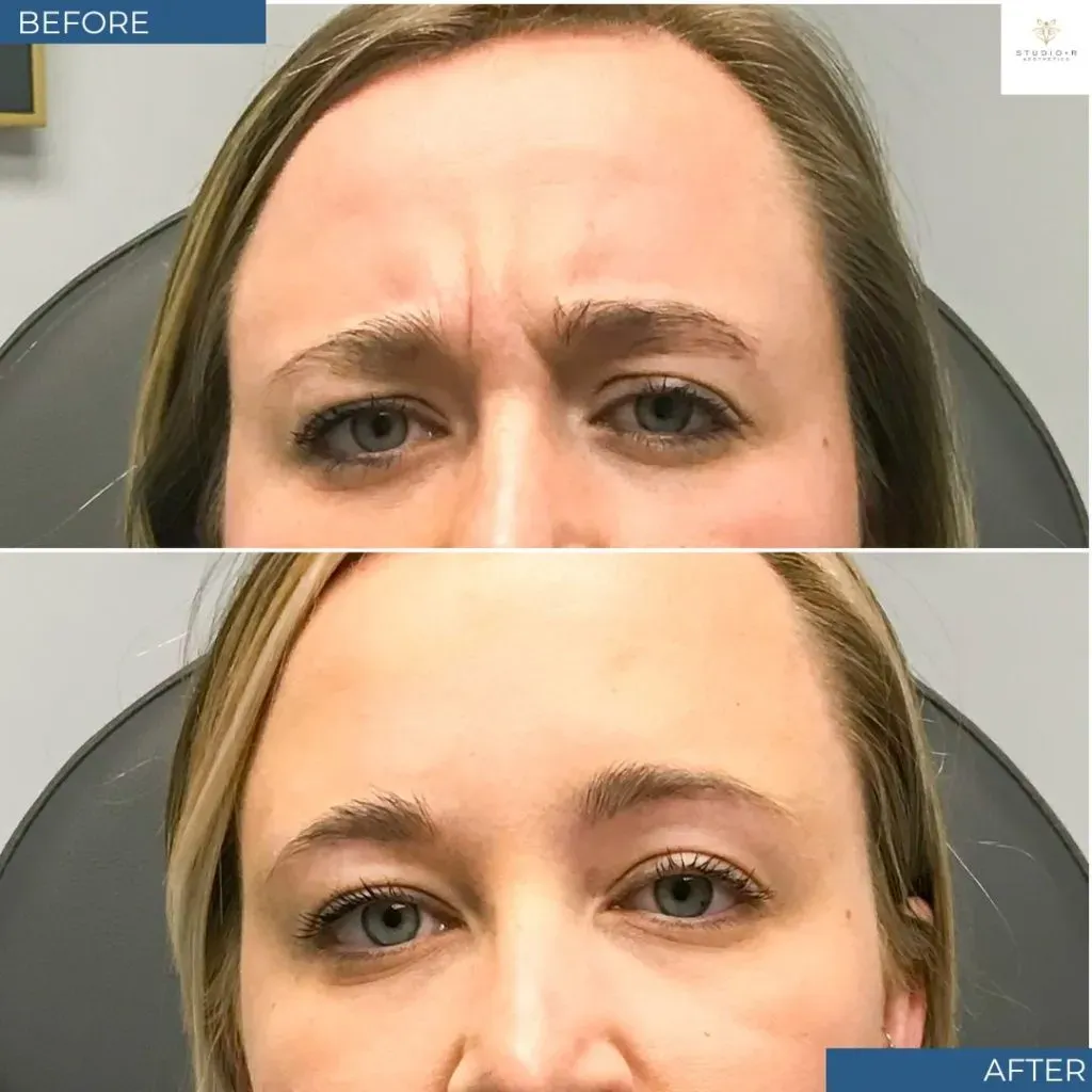 Botox Before & After