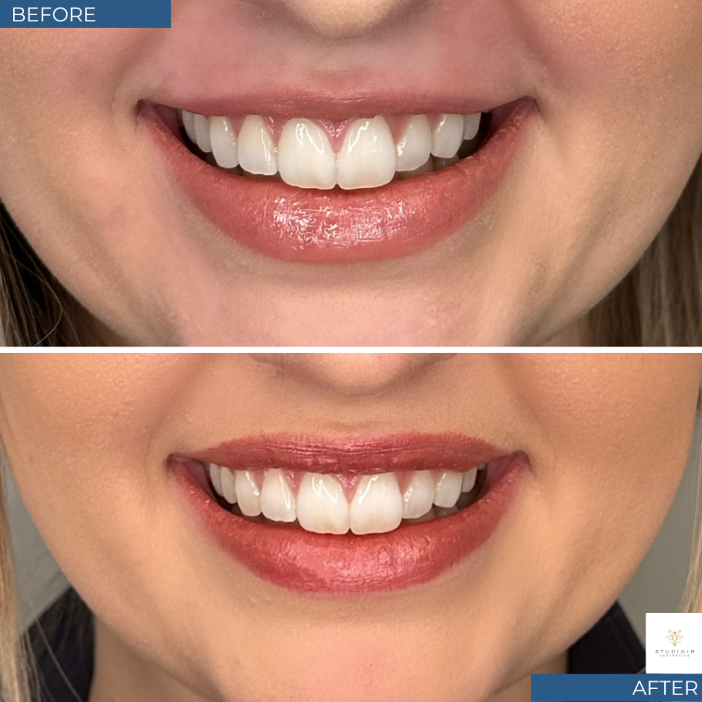 Botox Before & After