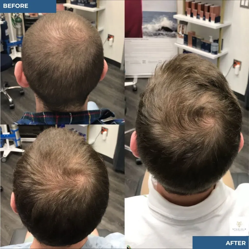 Hair Loss Before & After