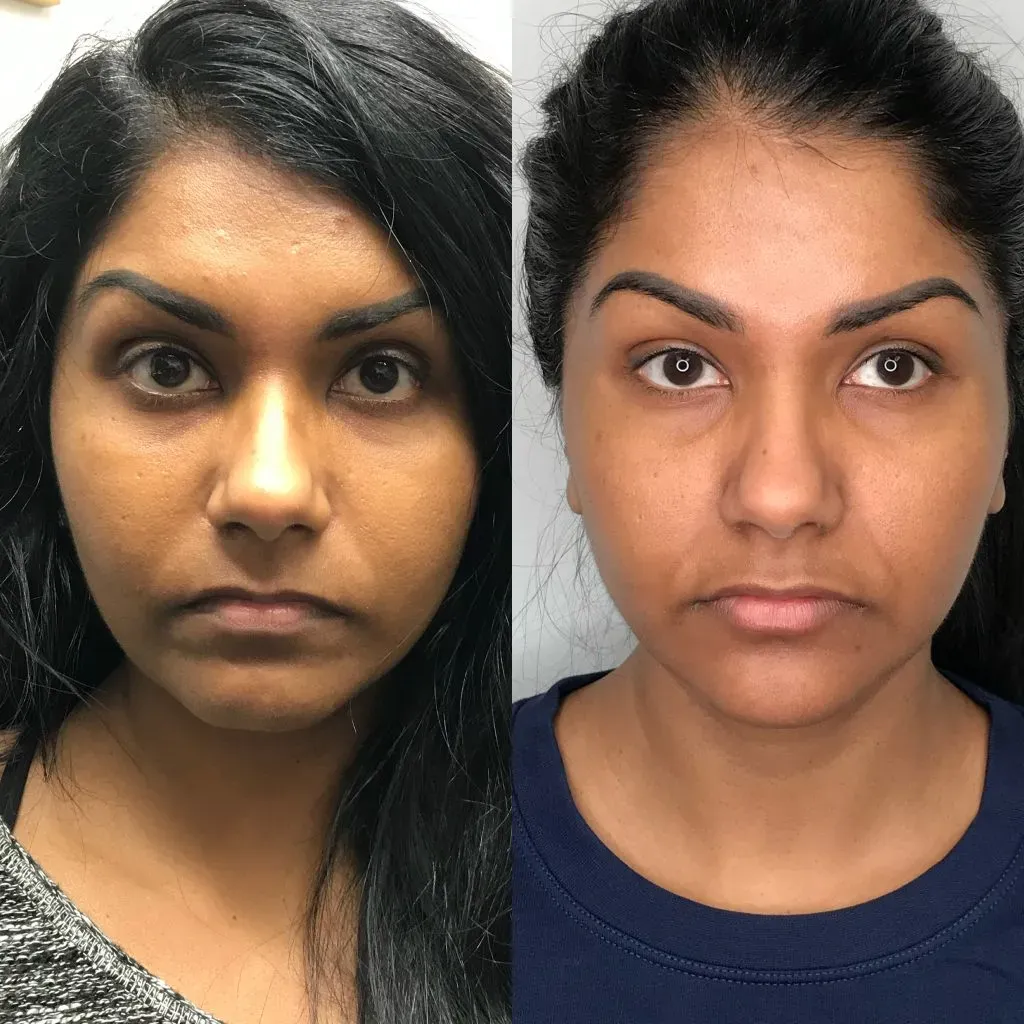 Coolpeel Deka Before & After