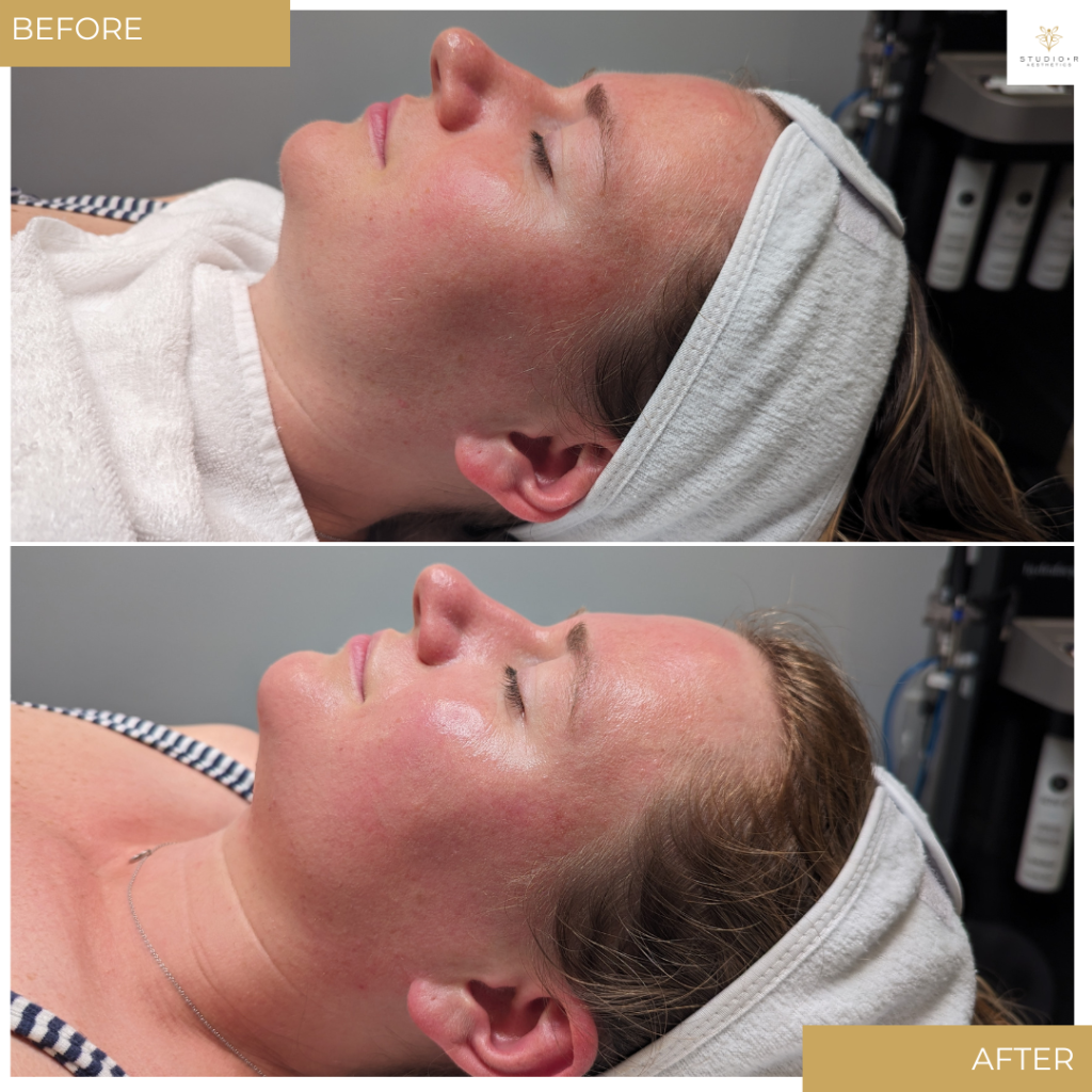 Esthetician Services Before & After
