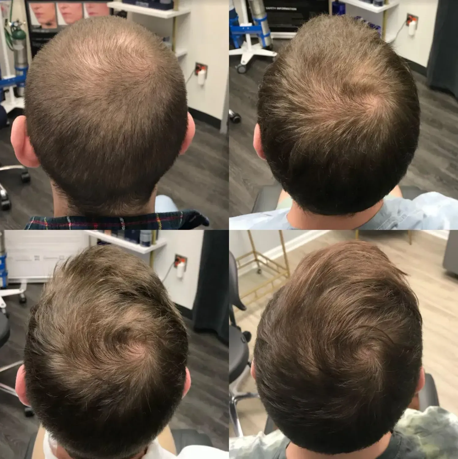 Hair restoration PRF