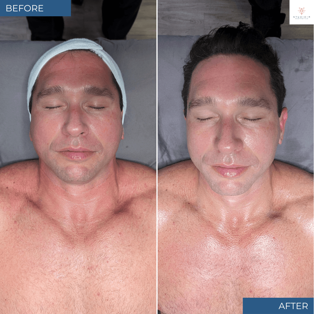 Platinum Hydrafacial Before and After at Studio R Aesthetics in Charlottesville Virginia