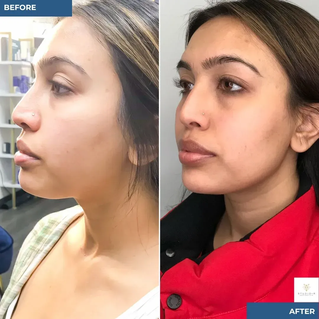 Dermal Filler for face and jawline Before and After at Studio R Aesthetics in Charlottesville Virginia