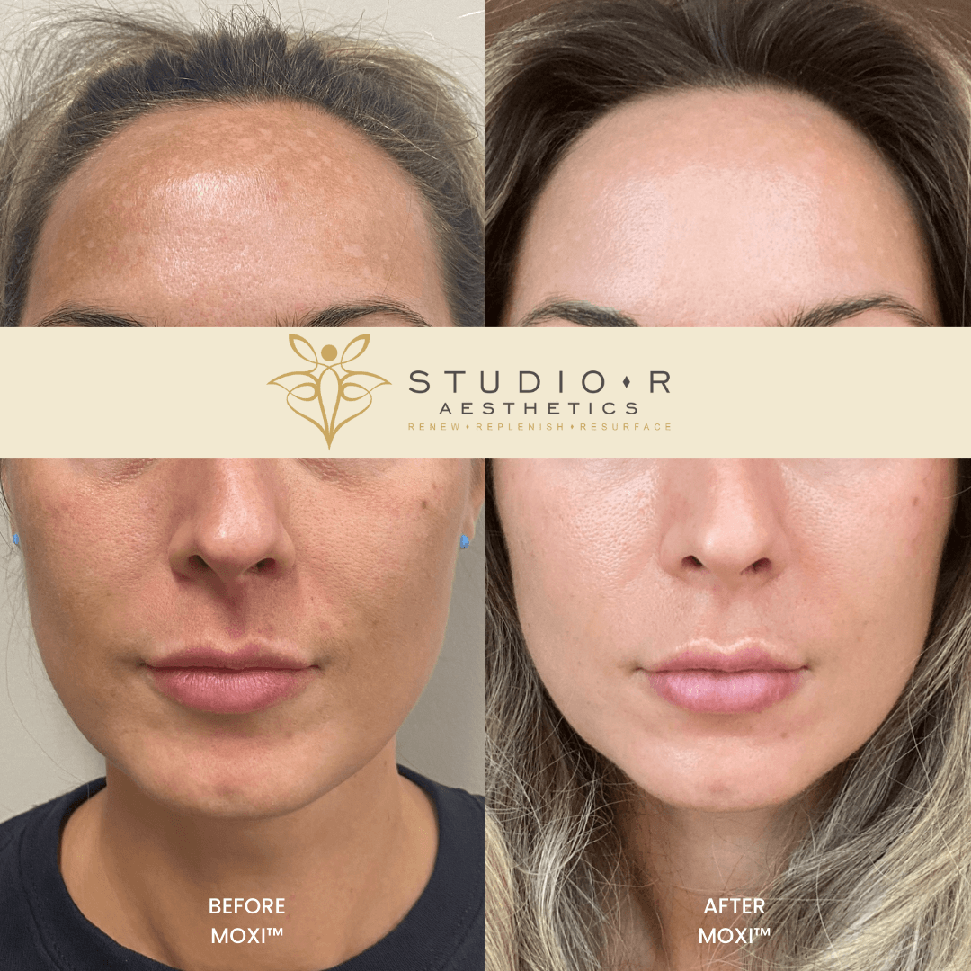 Moxi Laser Treatment for sun damage and discoloration before and after at Studio R Aesthetics in Charlottesville Virginia