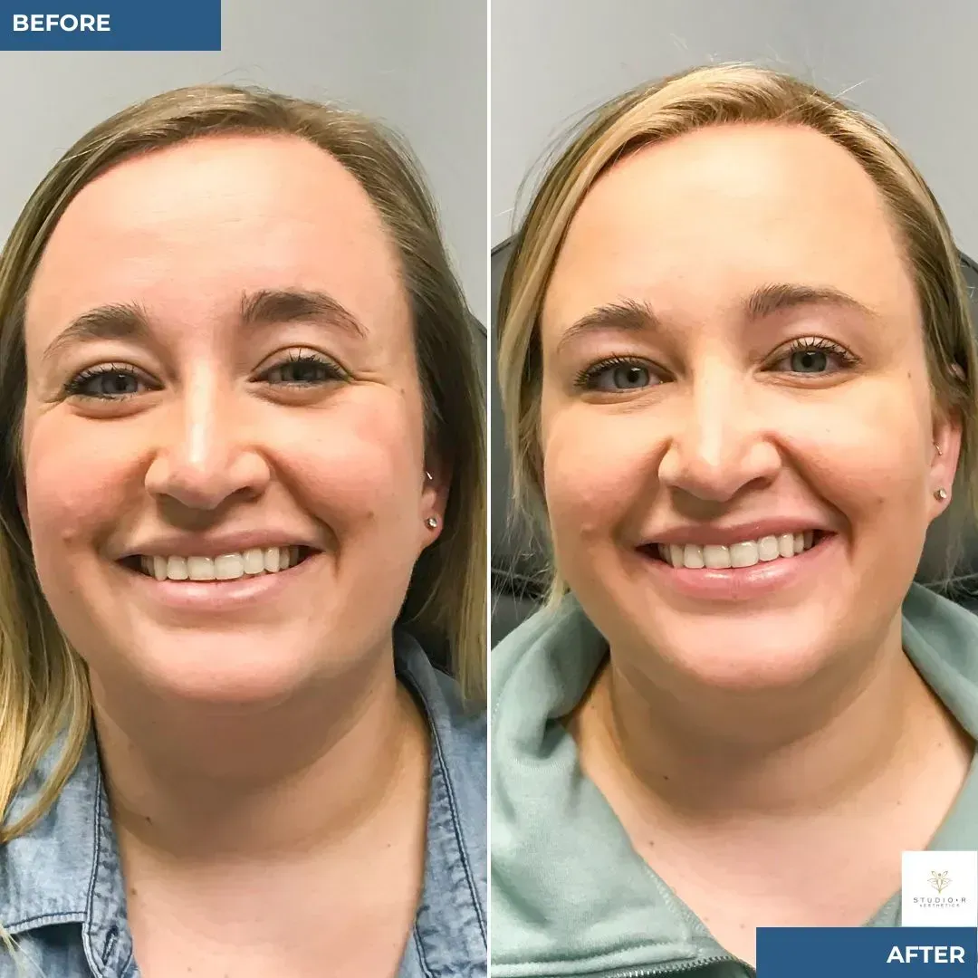 Dr. Segura's Signature Technique for Toxin Injections. Fine Lines and Wrinkles Before and After at Studio R Aesthetics in Charlottesville Virginia