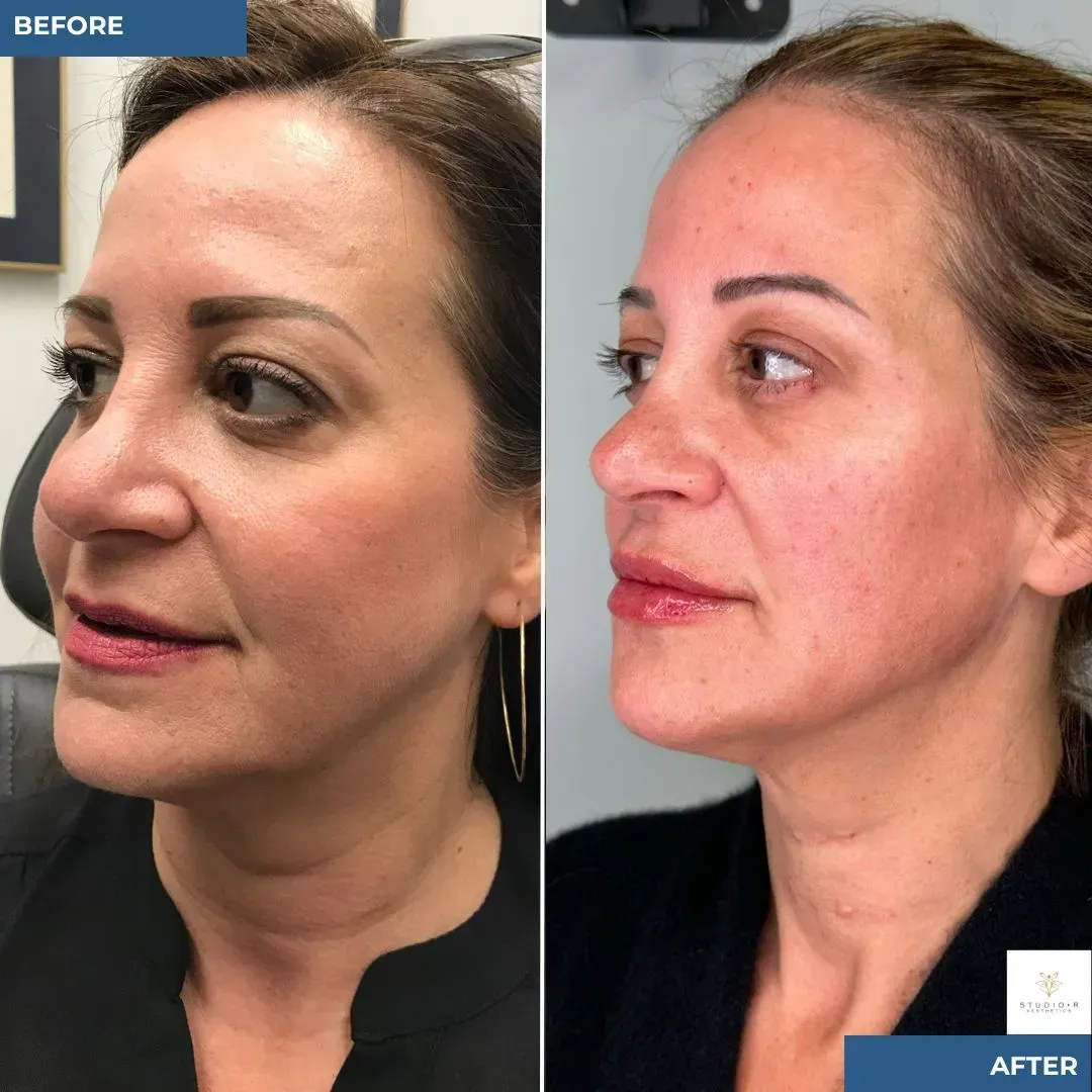 Dr. Segura's Signature Technique for Toxin Injections. Fine Lines and Wrinkles Before and After at Studio R Aesthetics in Charlottesville Virginia