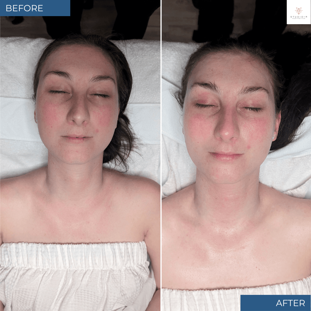 Customized Skin Treatment Before and After by Master Esthetician Michelle Morris in Charlottesville Virginia