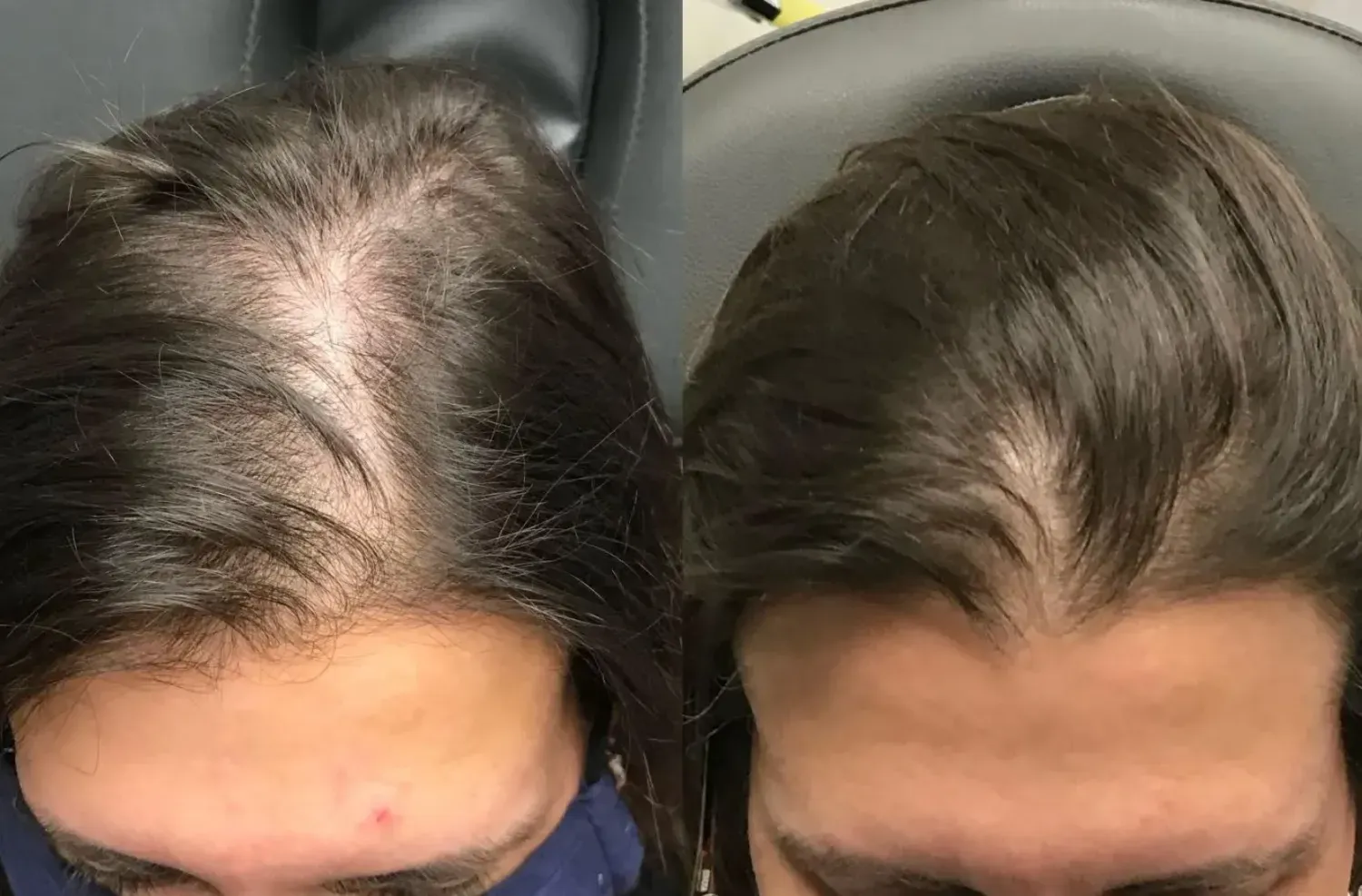 Hair restoration Nutrafol PRP